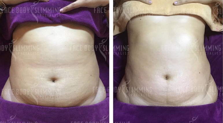 Body Slimming