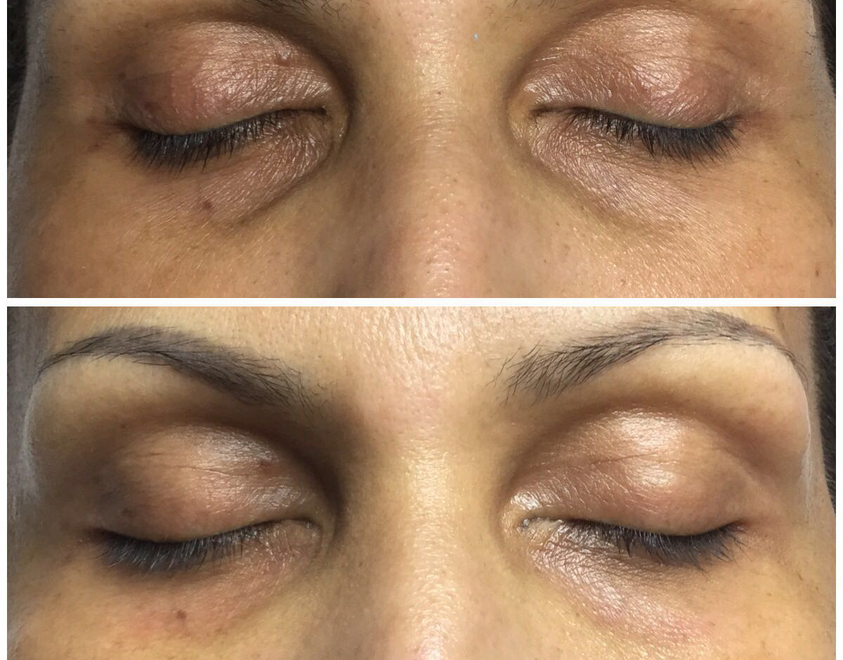 Skin Restoration