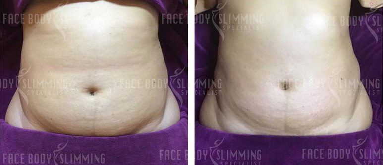 Body contour and shaping example