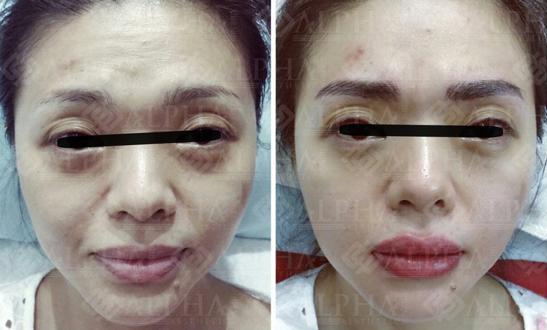 Face Lift & Rejuvenation