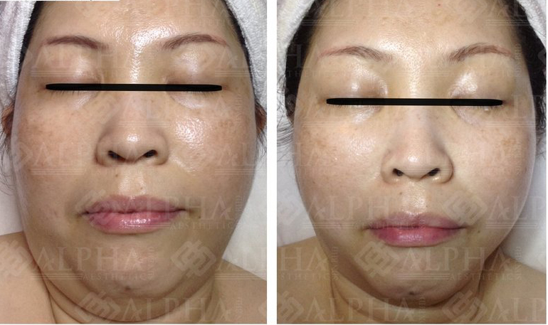 Face slimming example for facial balance