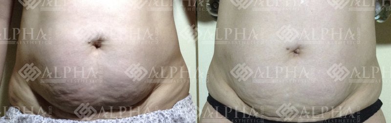 Targeted area slimming result example 2