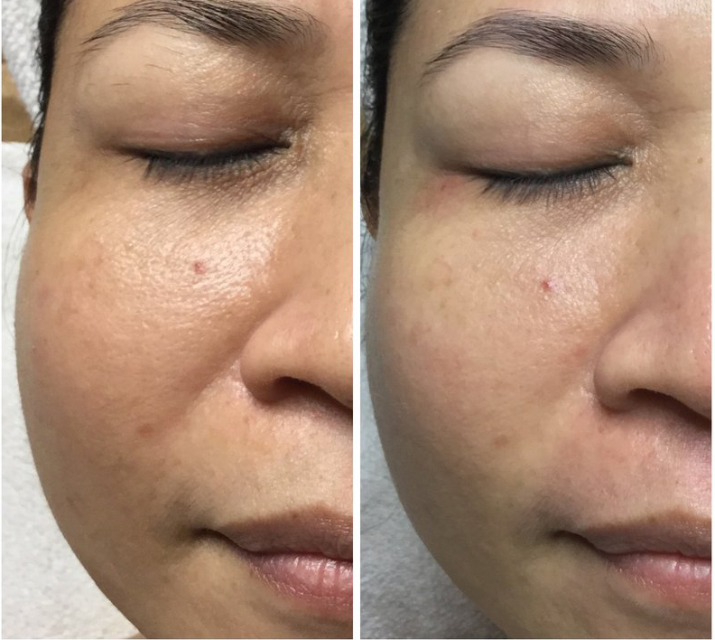 Skin recovery and eye-area example
