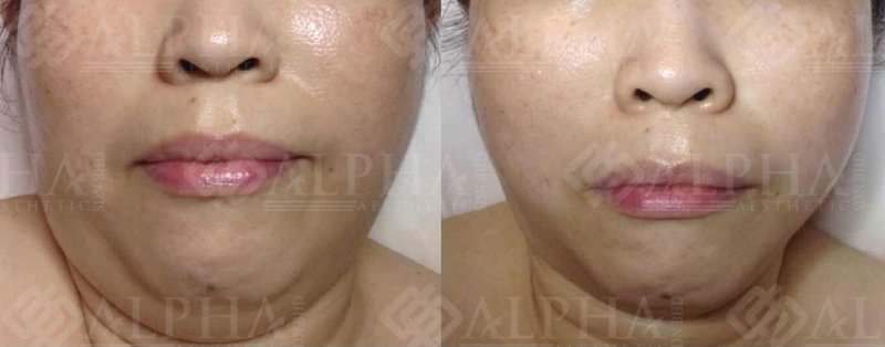 Face contour and skin-freshness example